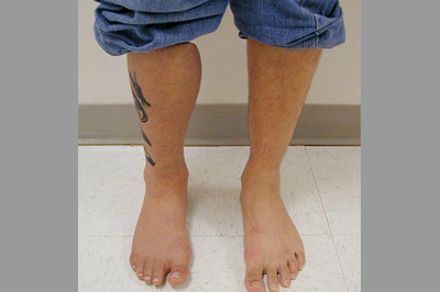 Alternative Prosthetic Services - above knee restoration replicating each patient's unique skin texture, color, and anatomy