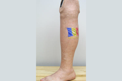 Alternative Prosthetic Services - below knee restoration - optional tattoo -  replicating each patient - Sunshine Prosthetics and Orthotics, NJ