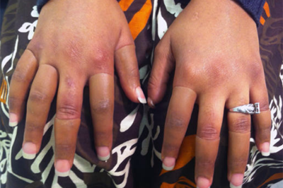 Alternative Prosthetic Services five finger restoration After