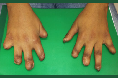 Alternative Prosthetic Services five finger restoration Before