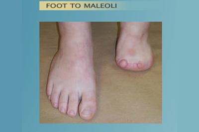 Alternative Prosthetic Services -  Foot to Maleoli before