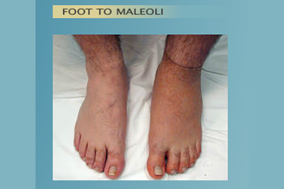 Alternative Prosthetic Services -  Foot to Maleoli before - replicating each patient's unique skin texture, color, and anatomy