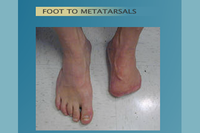 Alternative Prosthetic Services - Foot to Metatarsals before