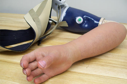 Alternative Prosthetic Services MYO electric hand restoration