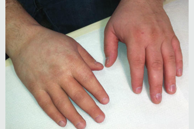 Alternative Prosthetic Services partial hand restoration After