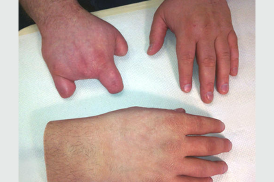 Alternative Prosthetic Services partial hand restoration Before
