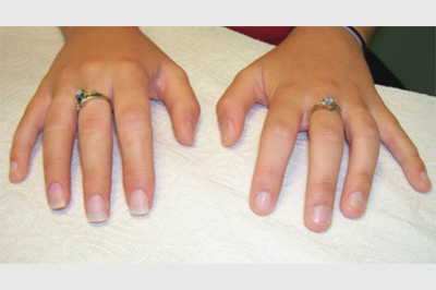 Alternative Prosthetic Services three finger restoration Afte