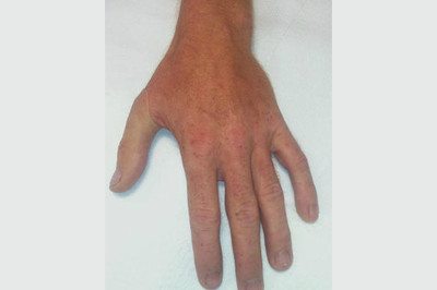 Alternative Prosthetic Services thumb restoration After