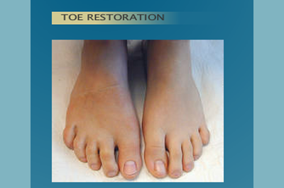 Alternative Prosthetic Services - Toe Restoration - replicating each patient's unique skin texture, color, and anatomy