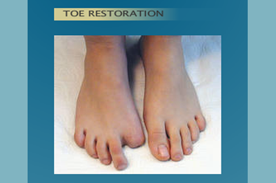 Alternative Prosthetic Services - Toe Restoration - before