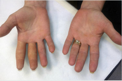 Alternative Prosthetic Services  two finger restoration After